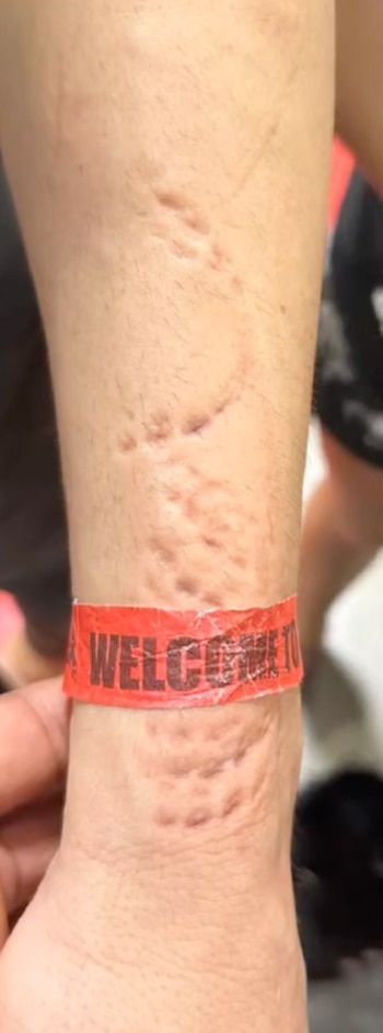 Bozovic mostró su brazo tras el combate